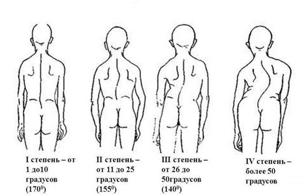 4 степени искривления позвоночника