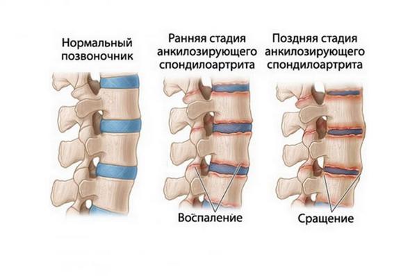 Болезнь Бехтерева, к сожалению, не лечится, однако можно приостановить ее развитие
