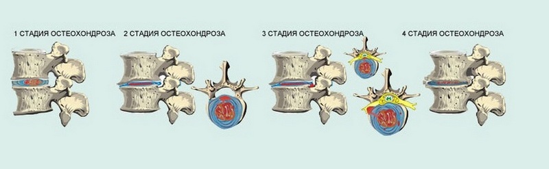 Выделяют несколько степеней остеохондроза
