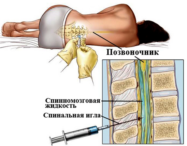 Миелограмма