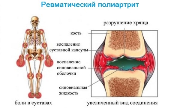 Избавиться от ревматического полиартрита, к счастью, не слишком трудно
