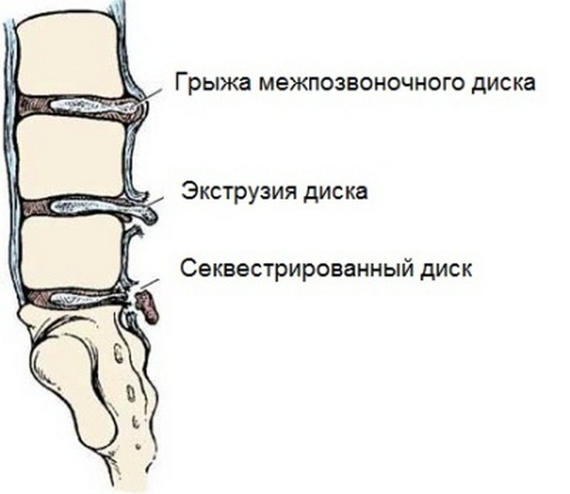 Последним этапом развития грыжи является секвестрация, избавиться от которой значительно сложнее