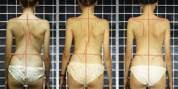 Избавиться от сколиоза второй степени, конечно, невероятно тяжело, однако если приложить усилия, можно добиться значительных улучшений