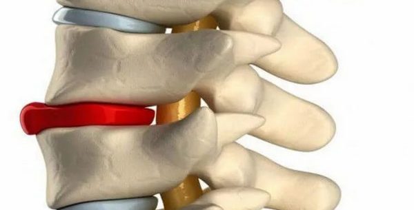 Жировая дегенерация позвонков может развиться из-за нарушенного питания клеток межпозвоночного диска