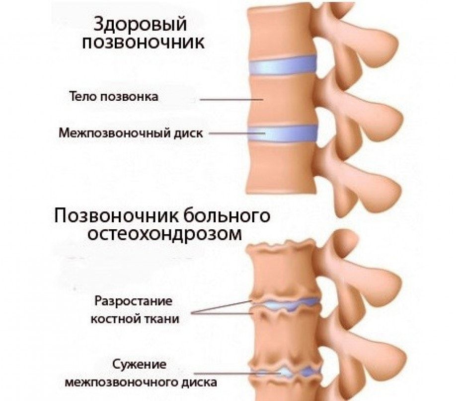 Остеохондроз