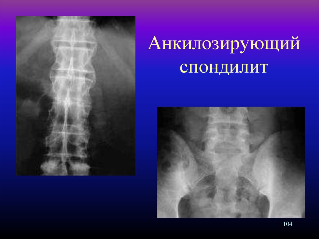 Анкилозирующий спондилит