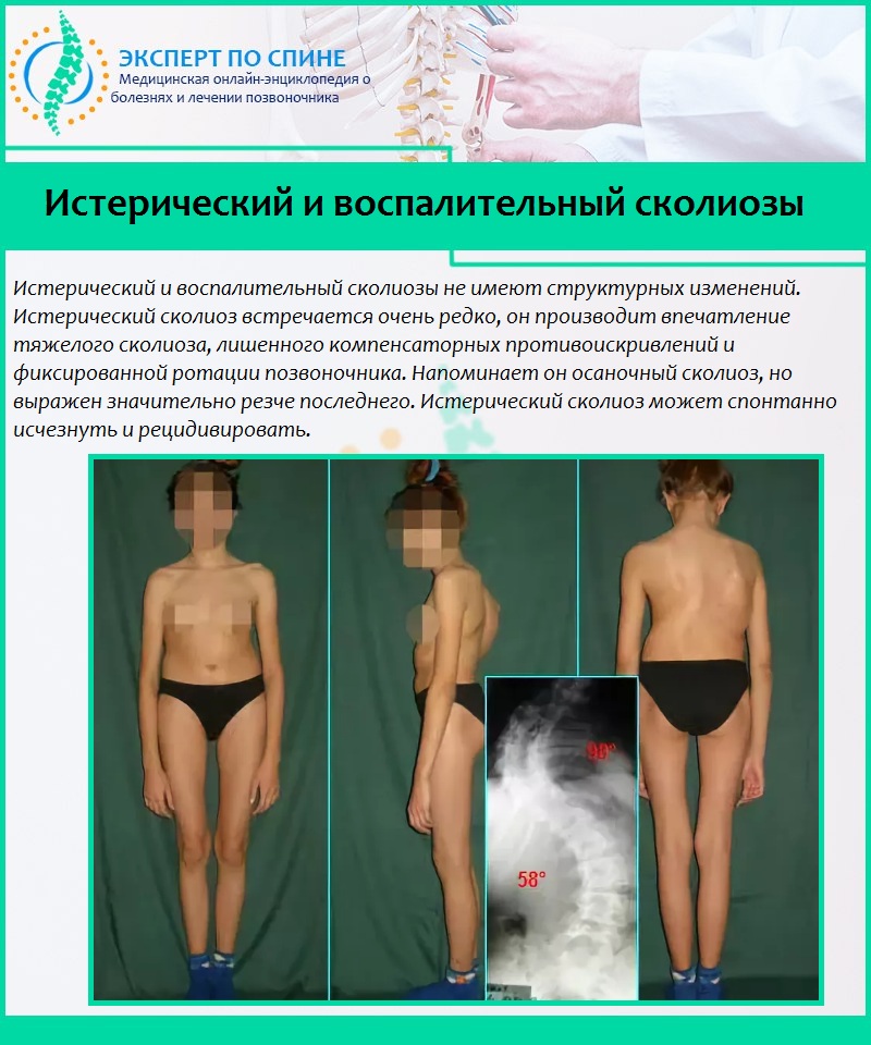 Истерический и воспалительный сколиозы