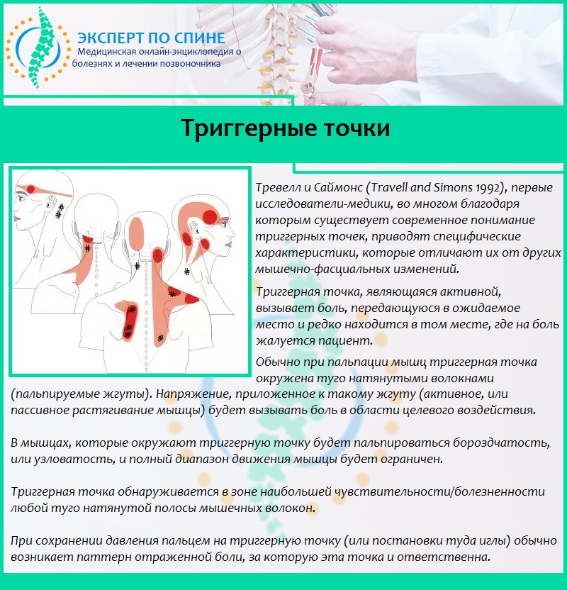 Tриггерные точки