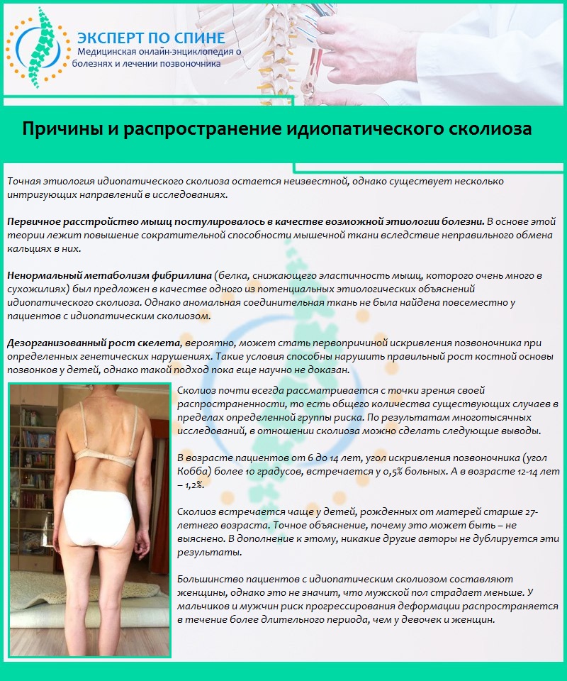 Причины и распространение идиопатического сколиоза