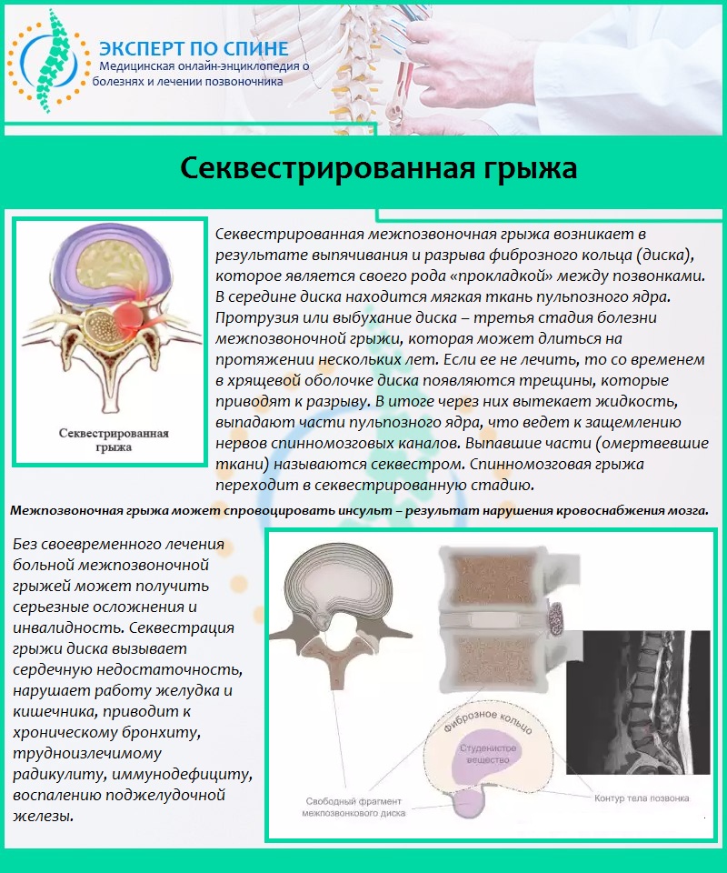 Секвестрированная грыжа