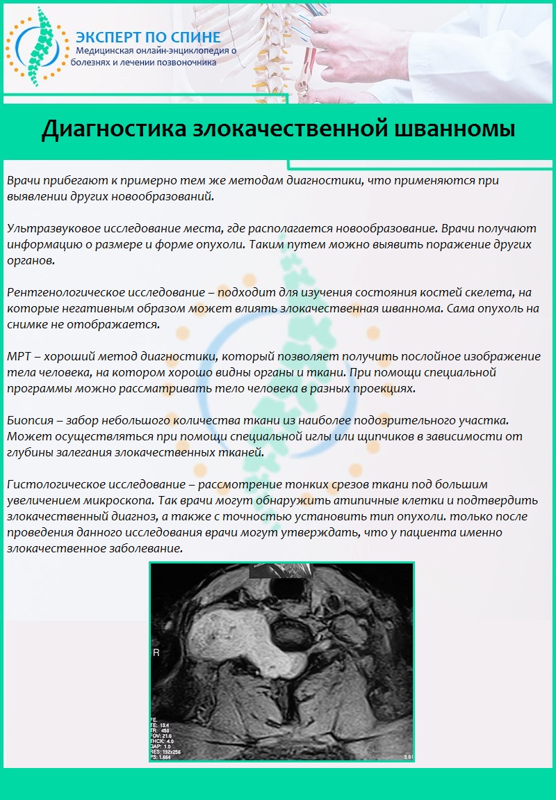 Диагностика злокачественной шванномы