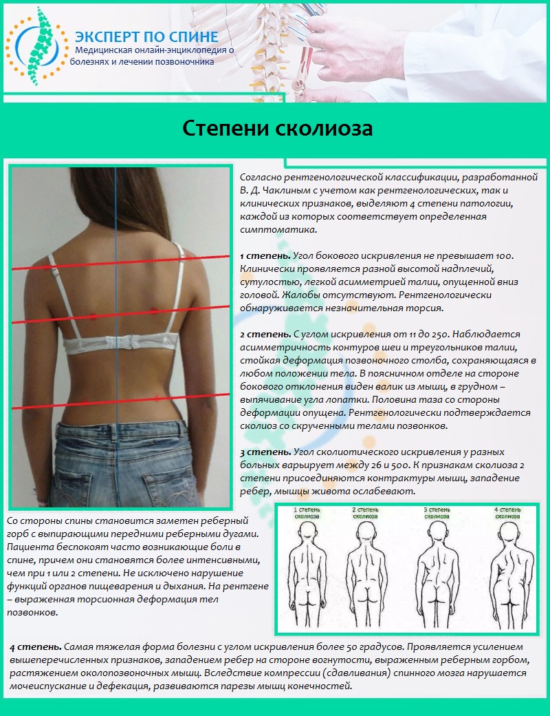 Степени сколиоза