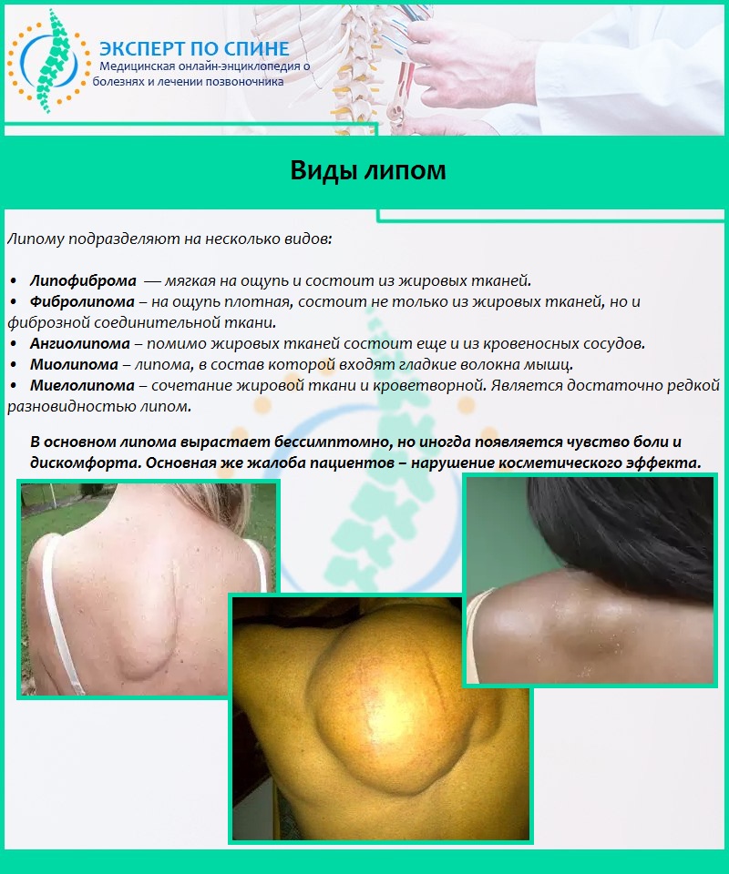 Виды липом