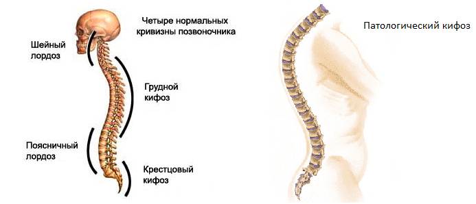 Кифоз бывает физиологическим и патологическим