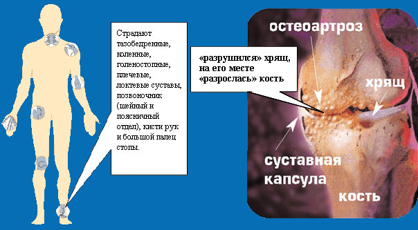 Части тела, наиболее часто страдающие от остеоартроза