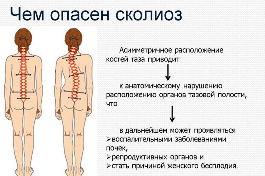 Чем опасен сколиоз