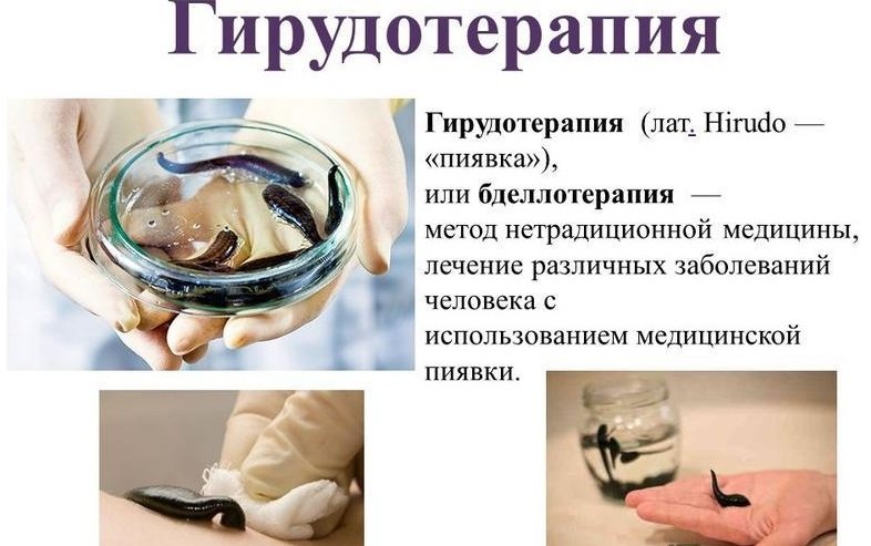 Что такое гирудотерапия