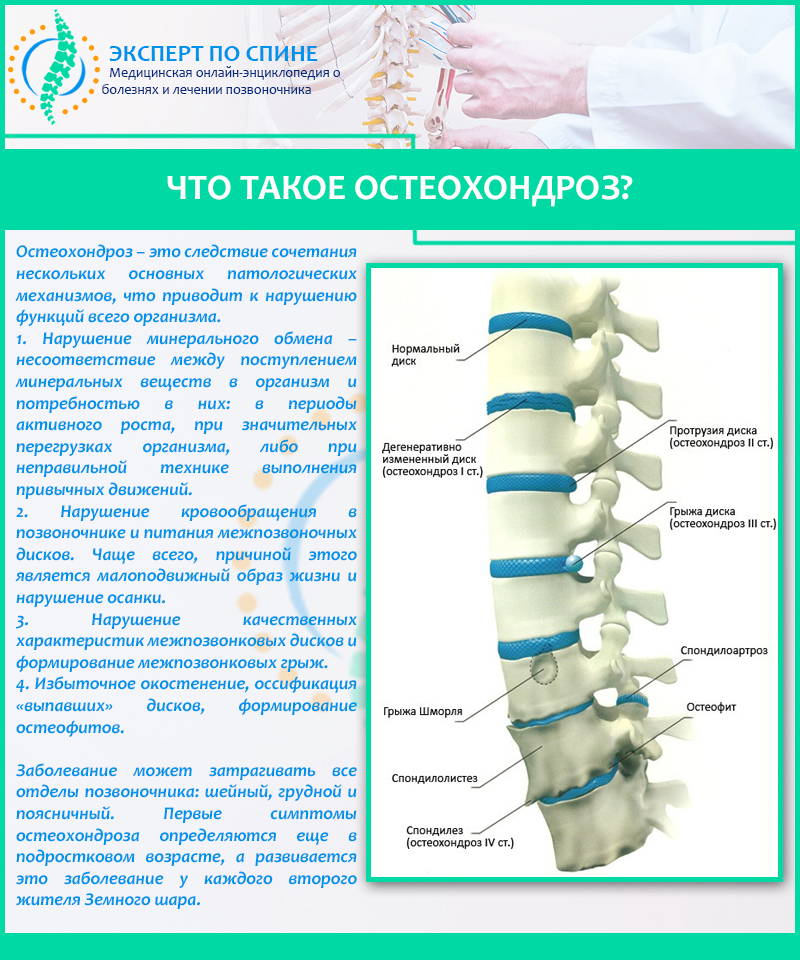 Что такое остеохондроз