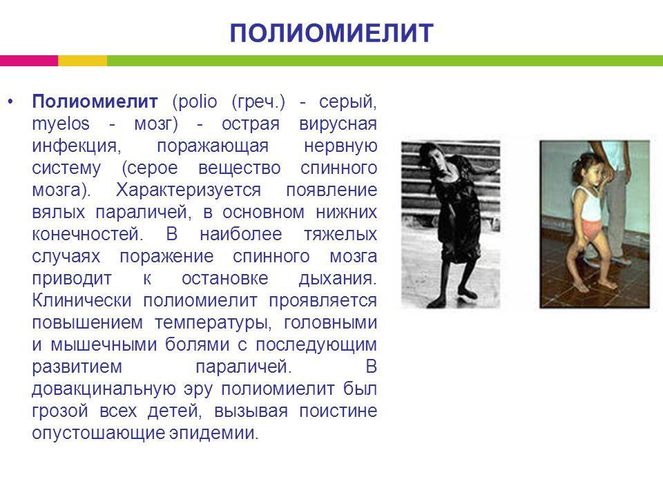 Что такое полиомиелит