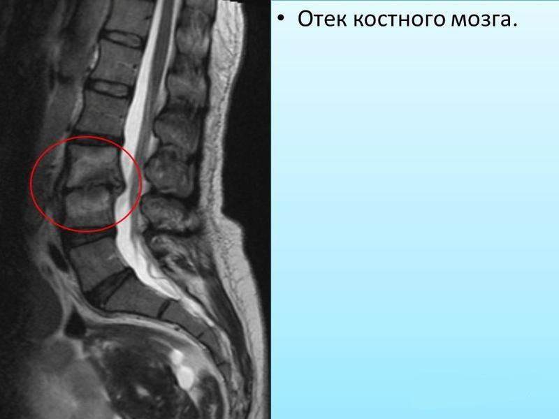 Диагностика отека костного мозга