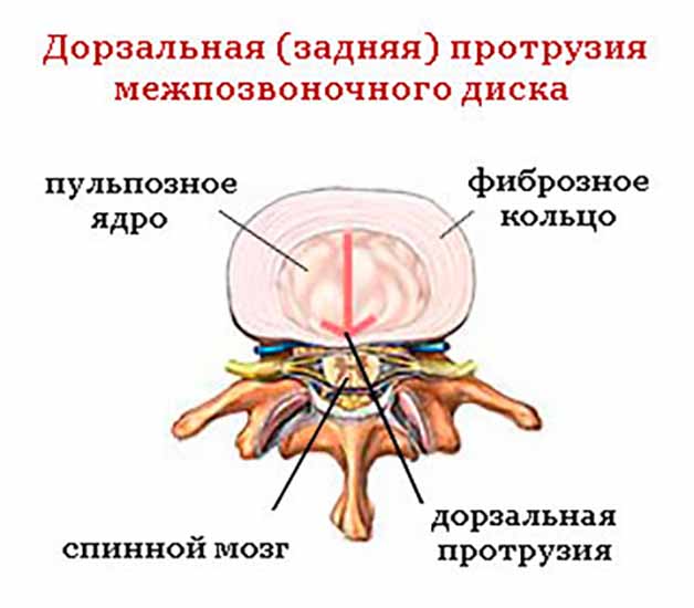 Дорзальное выпячивание межпозвонкового диска