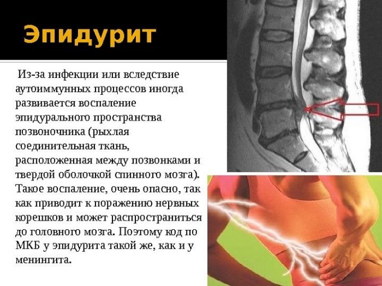 Эпидурит позвоночника 
