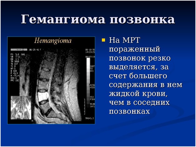 Гемангиома позвонка