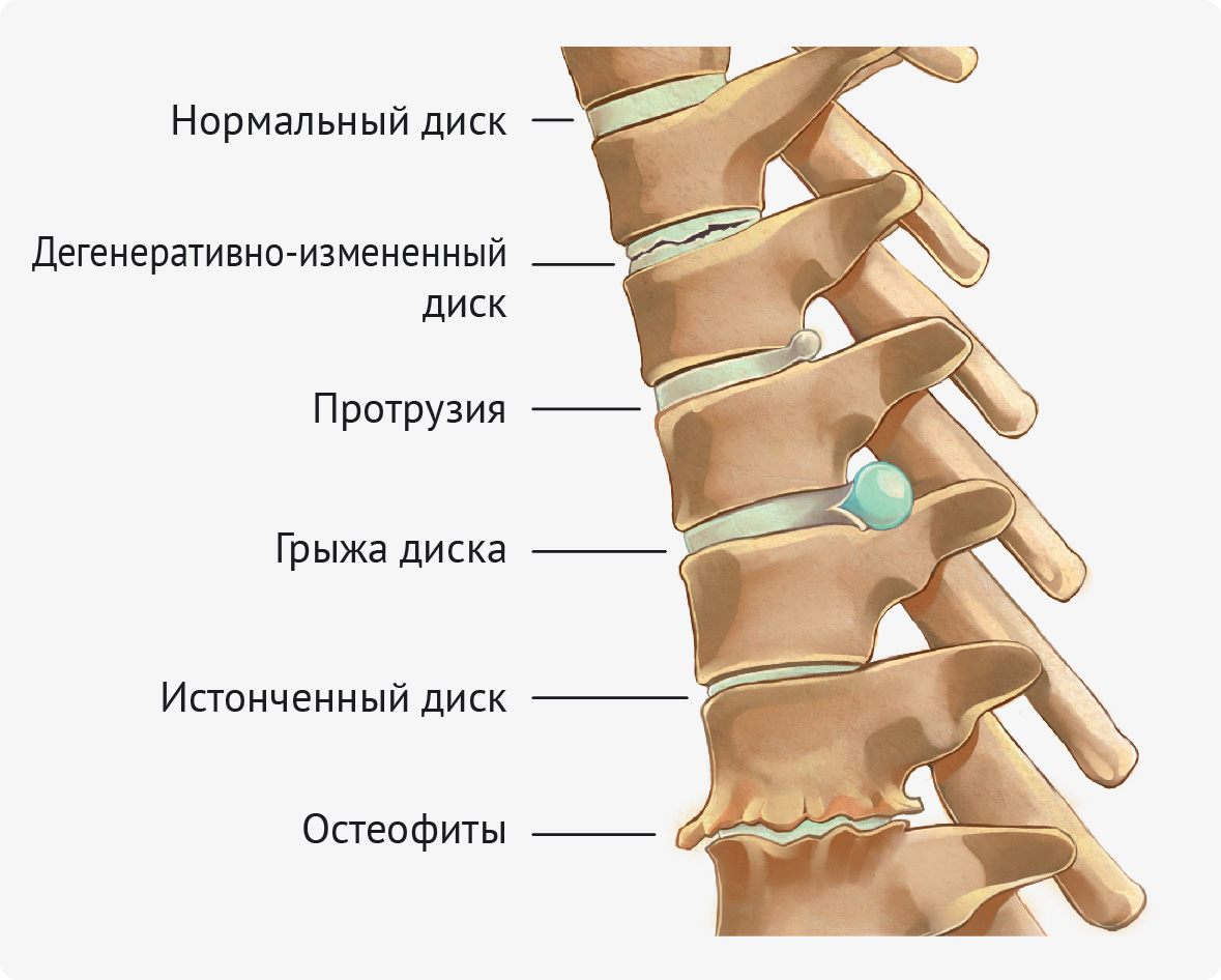 Грыжа межпозвонкового отдела — это смещение части деформированного межпозвоночного диска