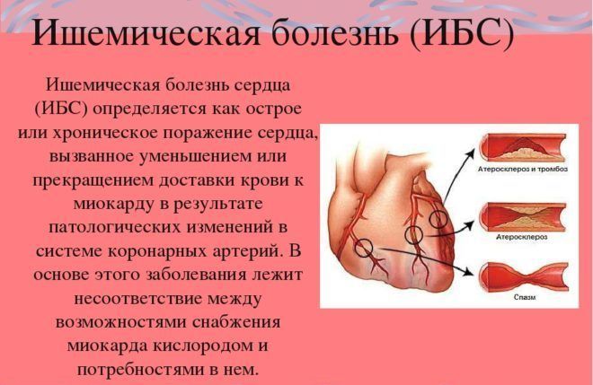 Ишемическая болезнь сердца (ИБС)