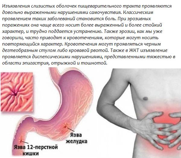 Изъязвление слизистой оболочки желудочно-кишечного тракта