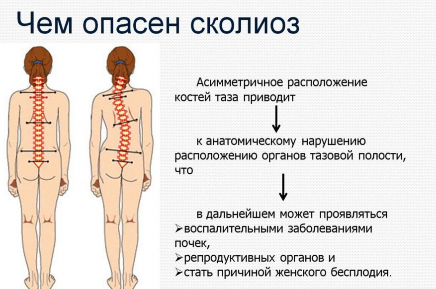К чему приводит сколиоз