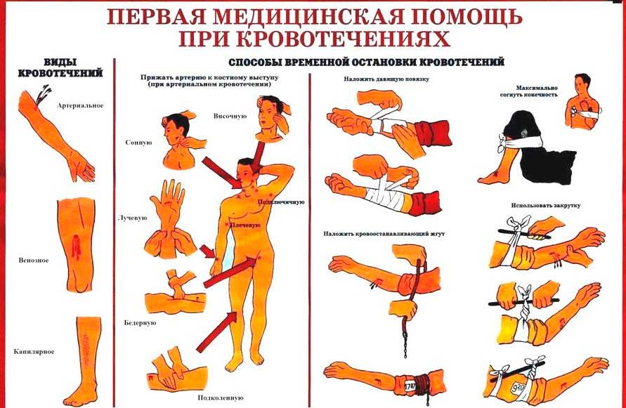 Как остановить кровотечение