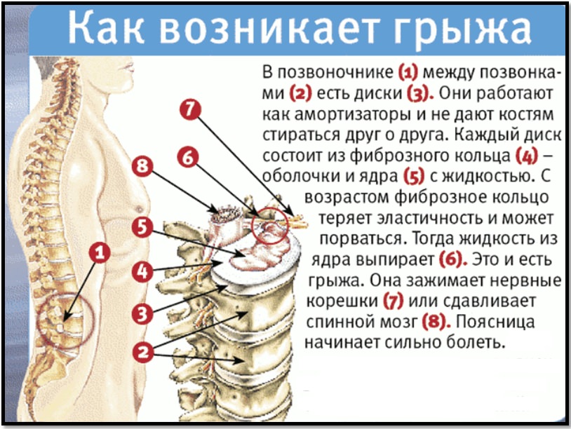 Как возникает грыжа
