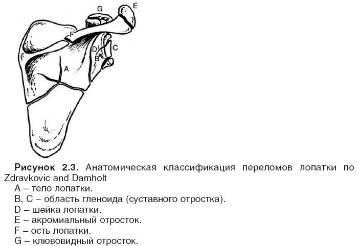 Классификация переломов лопатки
