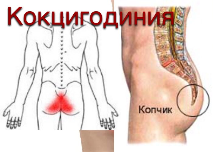 Кокцигодиния (боль в области копчика)
