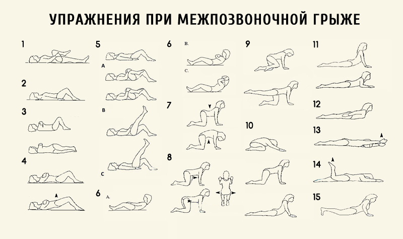 Комплекс упражнений при межпозвоночной грыже