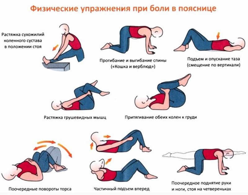 Лечебная физкультура - один из методов лечения радикулита