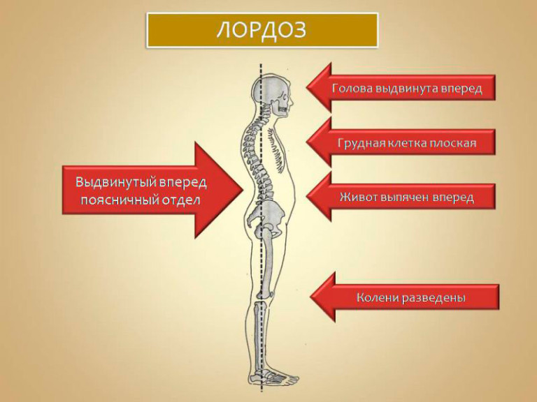 Лордоз, проявления