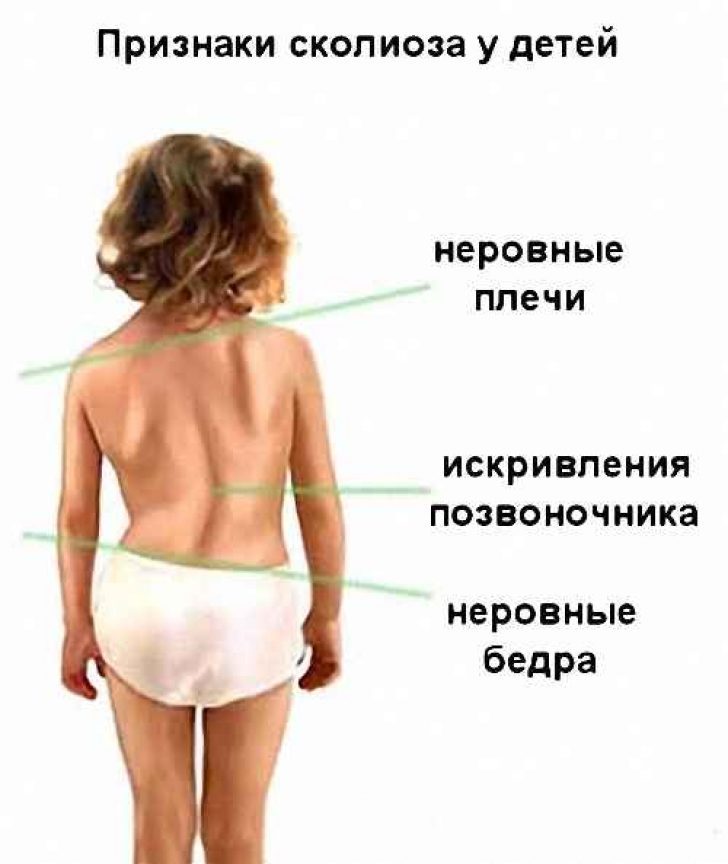 Наружные проявления сколиоза у детей