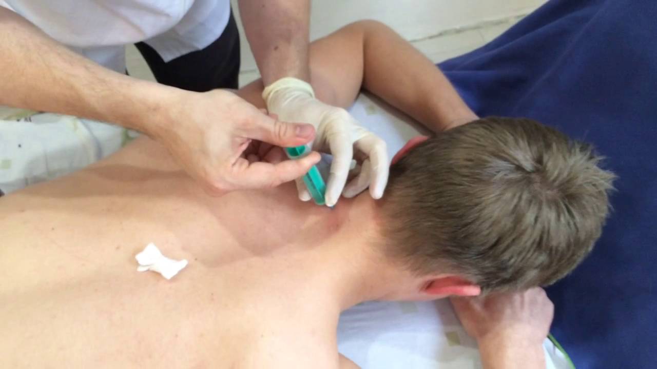 Новокаиновая блокада
