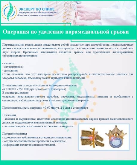 Операция по удалению парамедиальной грыжи 