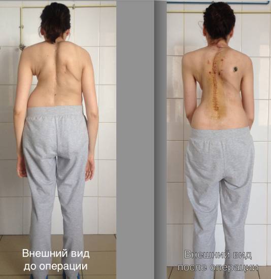Операция при сколиозе