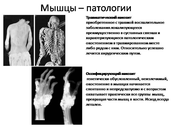 Описание оссифицирующего миозита