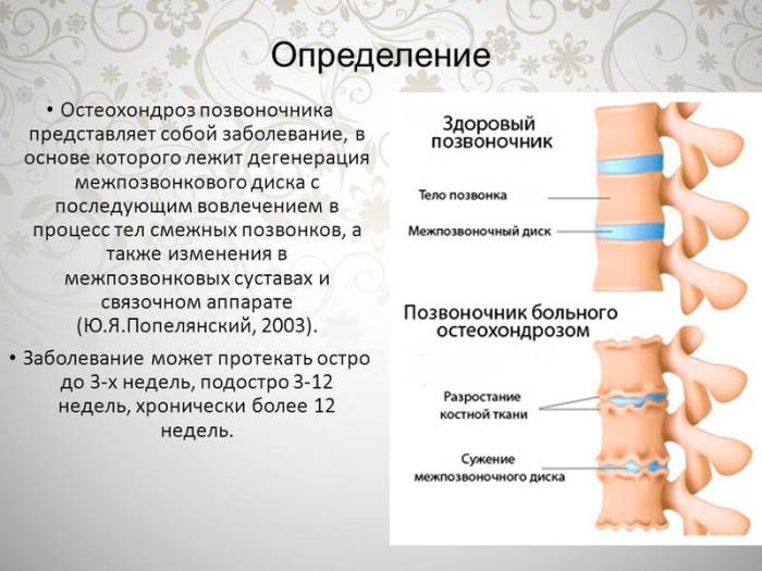 Определение остеохондроза