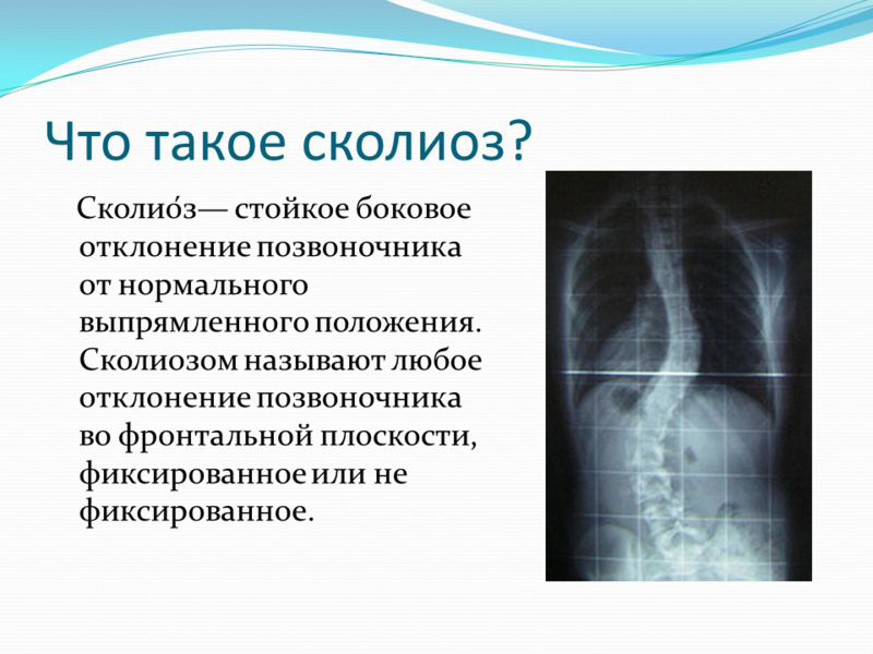 Определение сколиоза