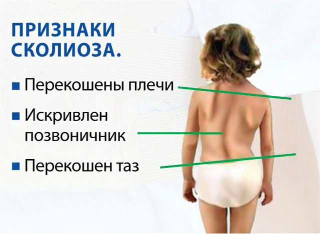 Основные признаки сколиоза