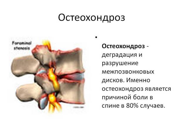 Остеохондроз