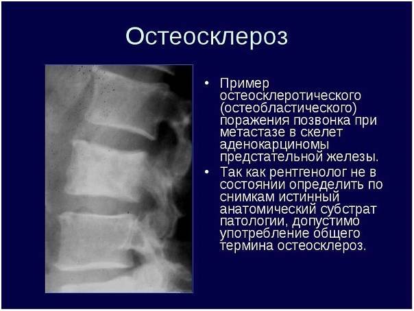 Остеосклеротическое поражение позвонка при метастазе