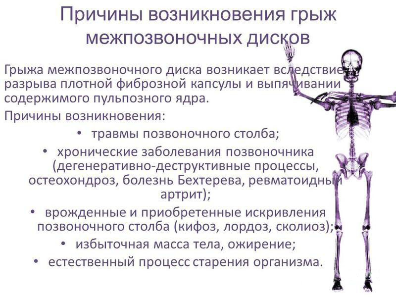 Почему возникают грыжи позвоночника