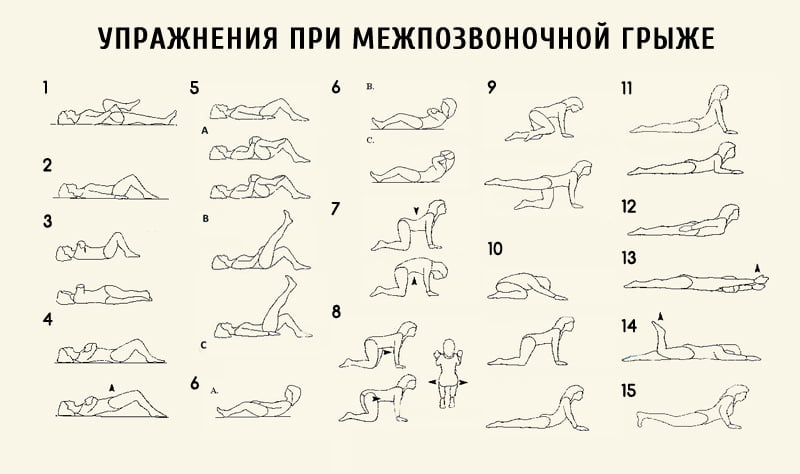 Полезные упражнения при грыже позвоночника